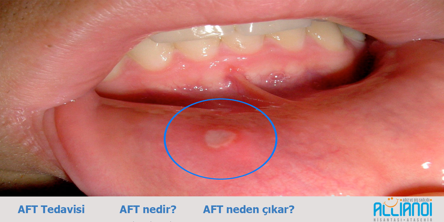 AFT Hastalığı Nedir AFT Hastalığı Nedir